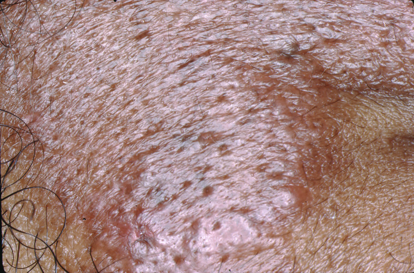 Granuloma faciale